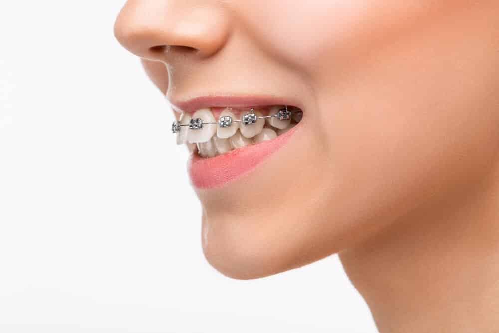 fiksna proteza za zube